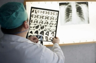 Tuberculosis