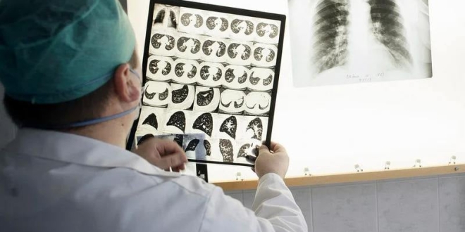 Tuberculosis